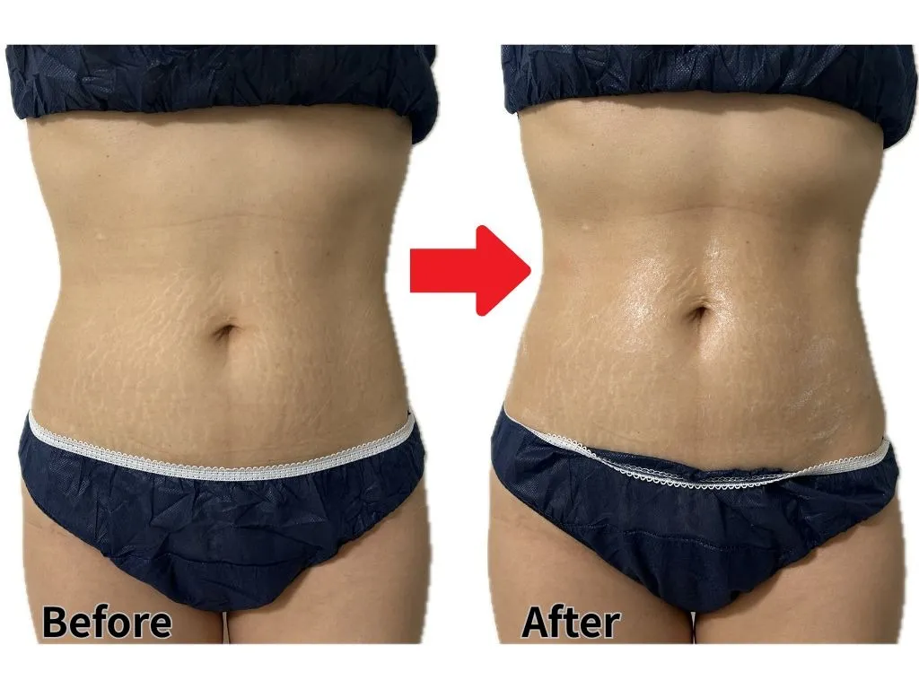 最高濃度脂肪溶解剤導入20分1回症例（腹部）