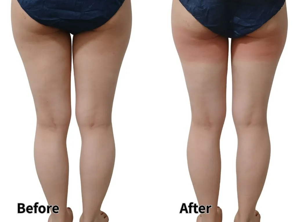 オーダーメイド脂肪冷却術120分当日変化