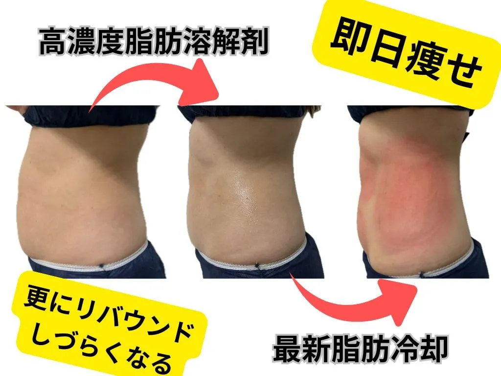 最高濃度脂肪溶解剤×脂肪冷却4カップ、施術当日の変化