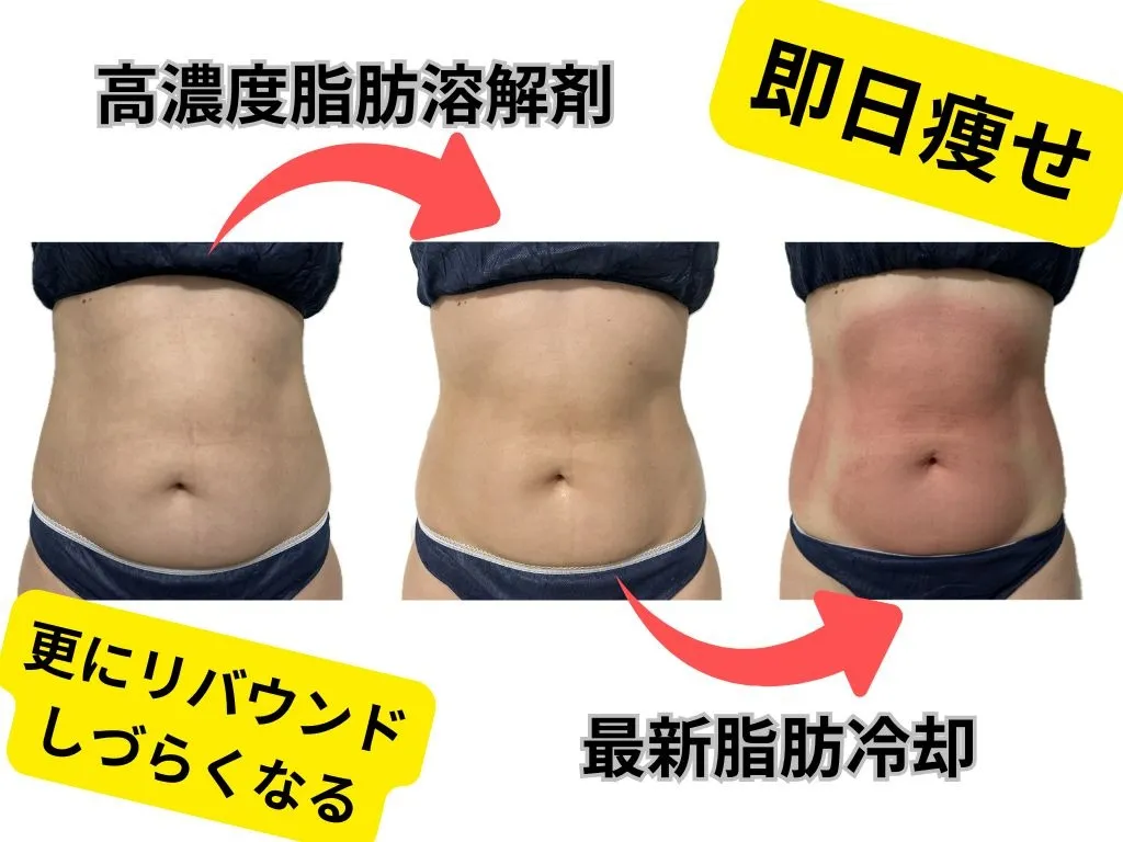 最高濃度脂肪溶解剤×脂肪冷却4カップ、施術当日の変化