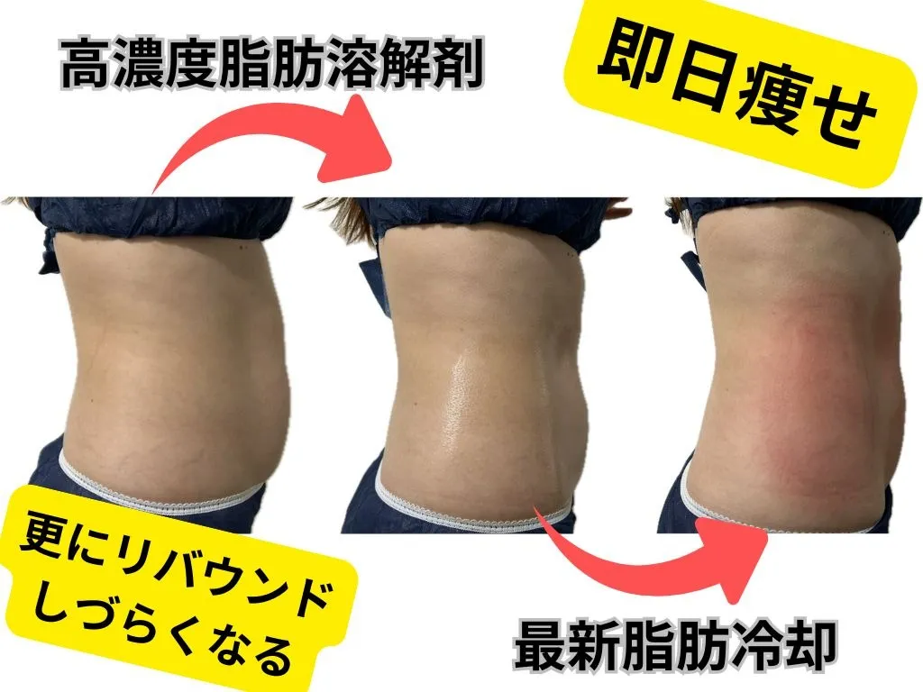 最高濃度脂肪溶解剤×脂肪冷却4カップ、施術当日の変化