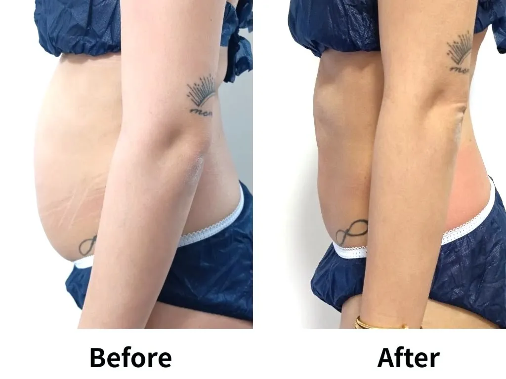 最高濃度脂肪溶解剤×脂肪冷却８カップ×3回施術後の変化