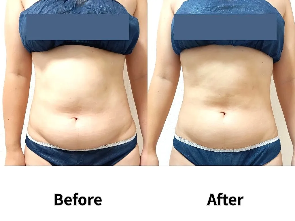 最高濃度脂肪溶解剤×脂肪冷却