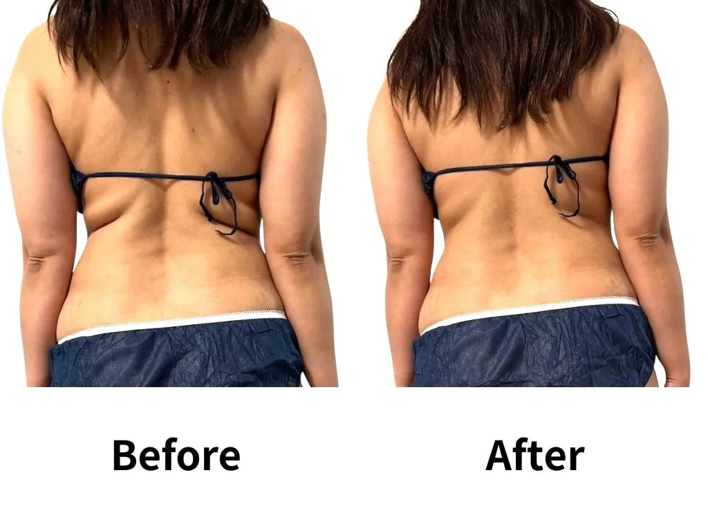 オーダーメイド脂肪冷却術　当日変化