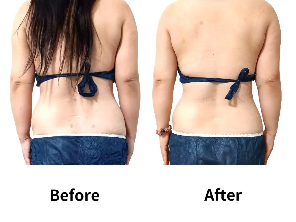 脂肪冷却×脂肪溶解剤導入お腹モニター