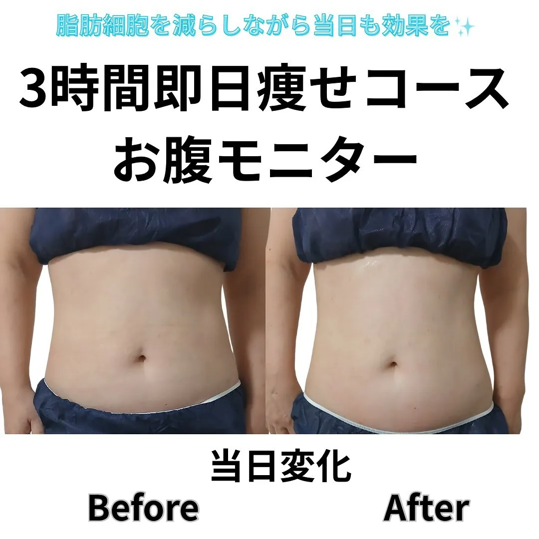 腕の脂肪冷却で通ってくださっていたお客様。