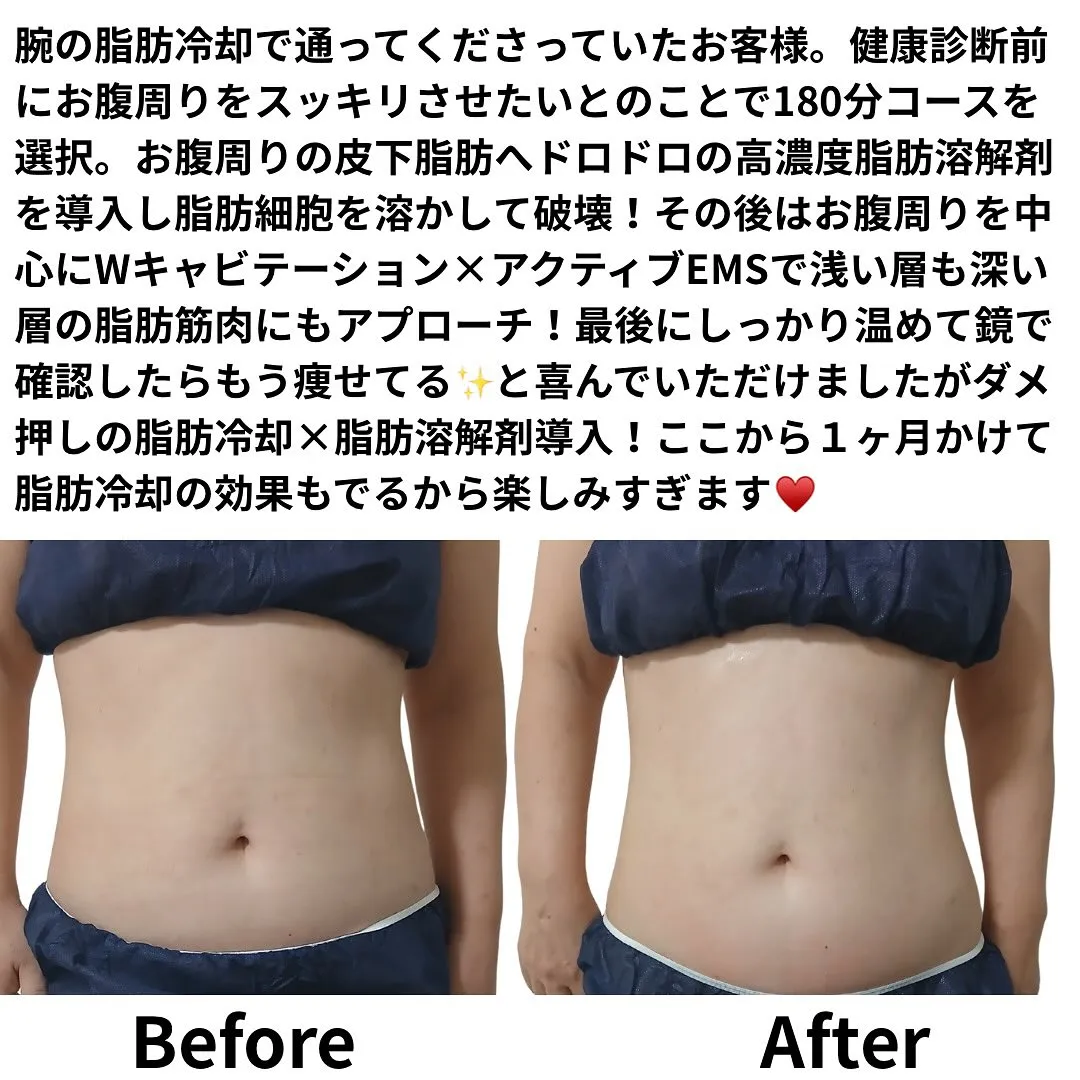腕の脂肪冷却で通ってくださっていたお客様。