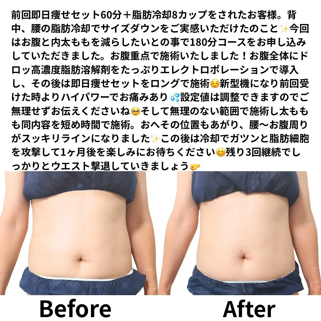 前回即日痩せセット60分＋脂肪冷却8カップをされたお客様。