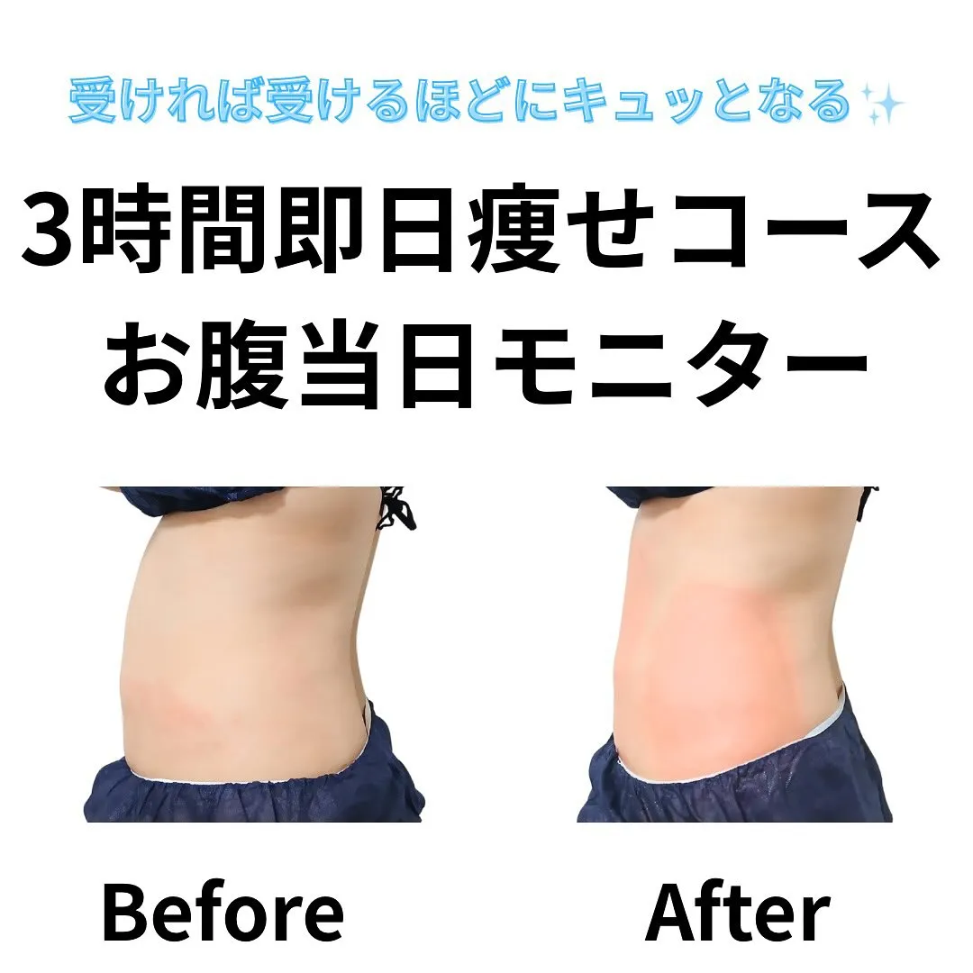 脂肪冷却回数券で通われていたお客様。