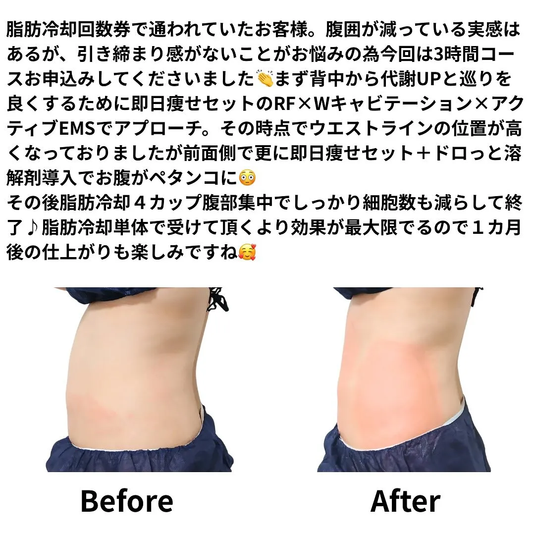 脂肪冷却回数券で通われていたお客様。