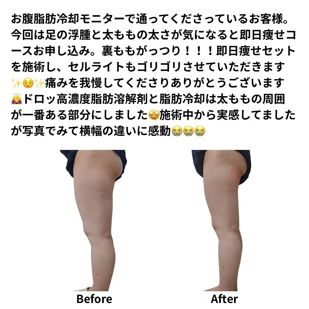 お腹脂肪冷却モニターで通ってくださっているお客様。