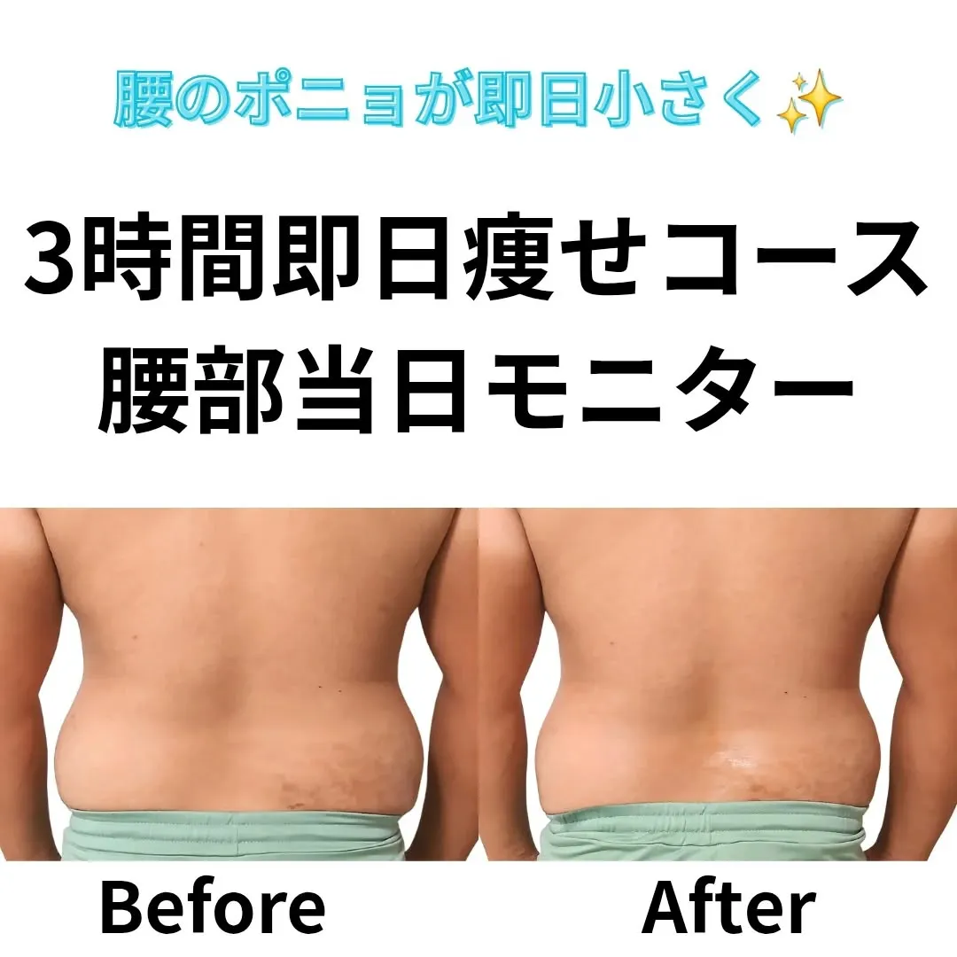 脂肪冷却で通っていただいているお客様。