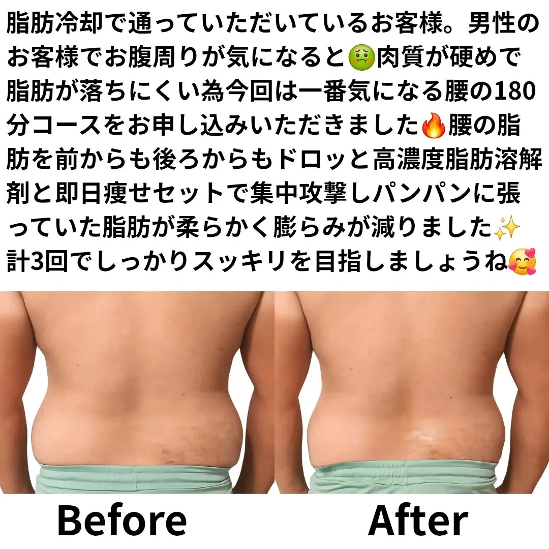 脂肪冷却で通っていただいているお客様。