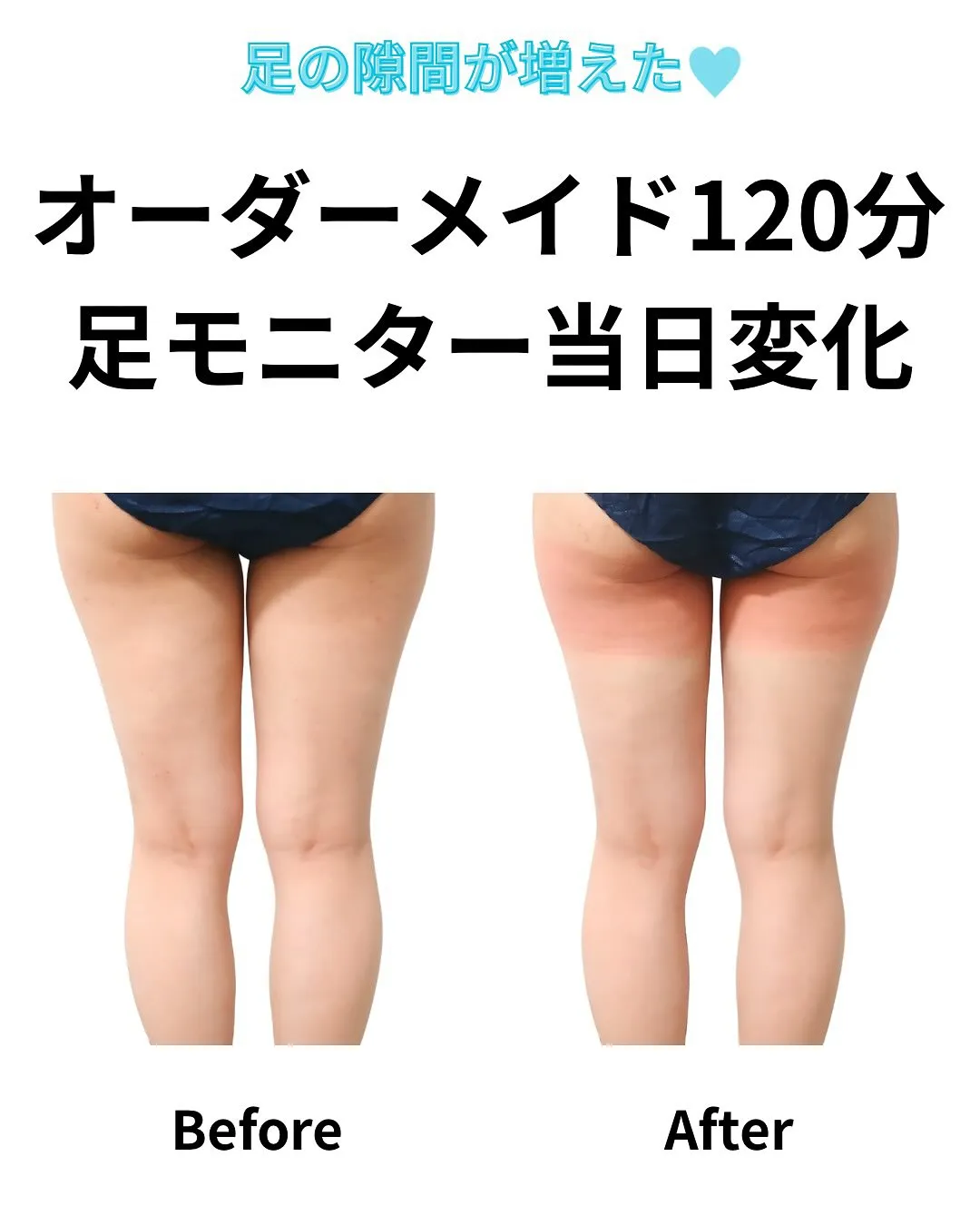 足の脂肪冷却で通われていたお客様