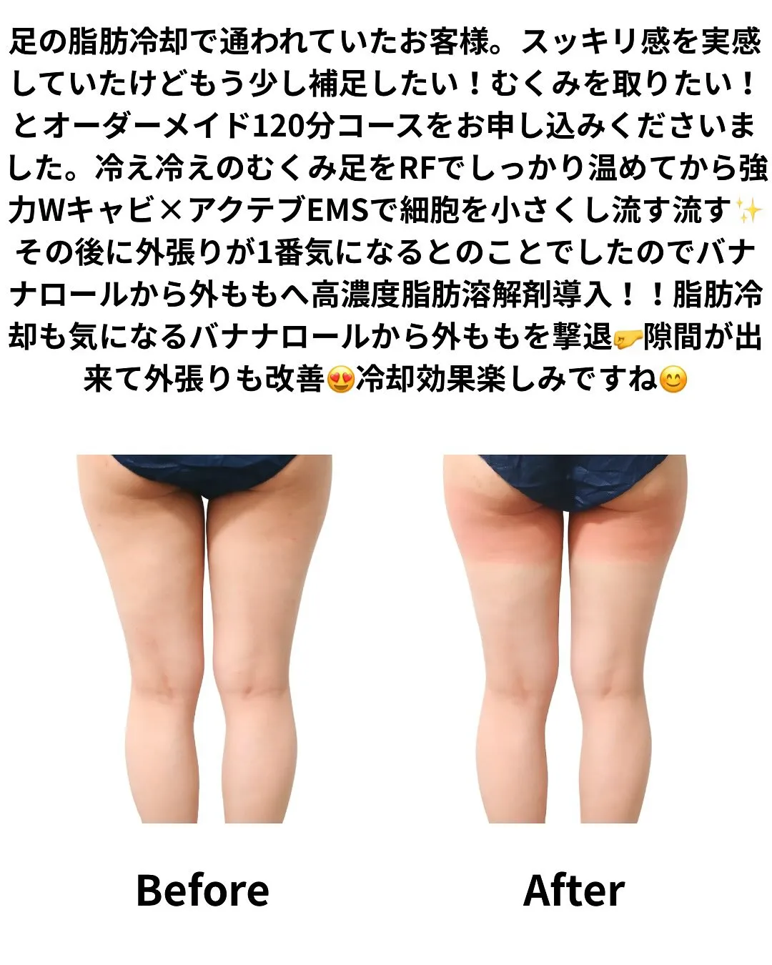 足の脂肪冷却で通われていたお客様