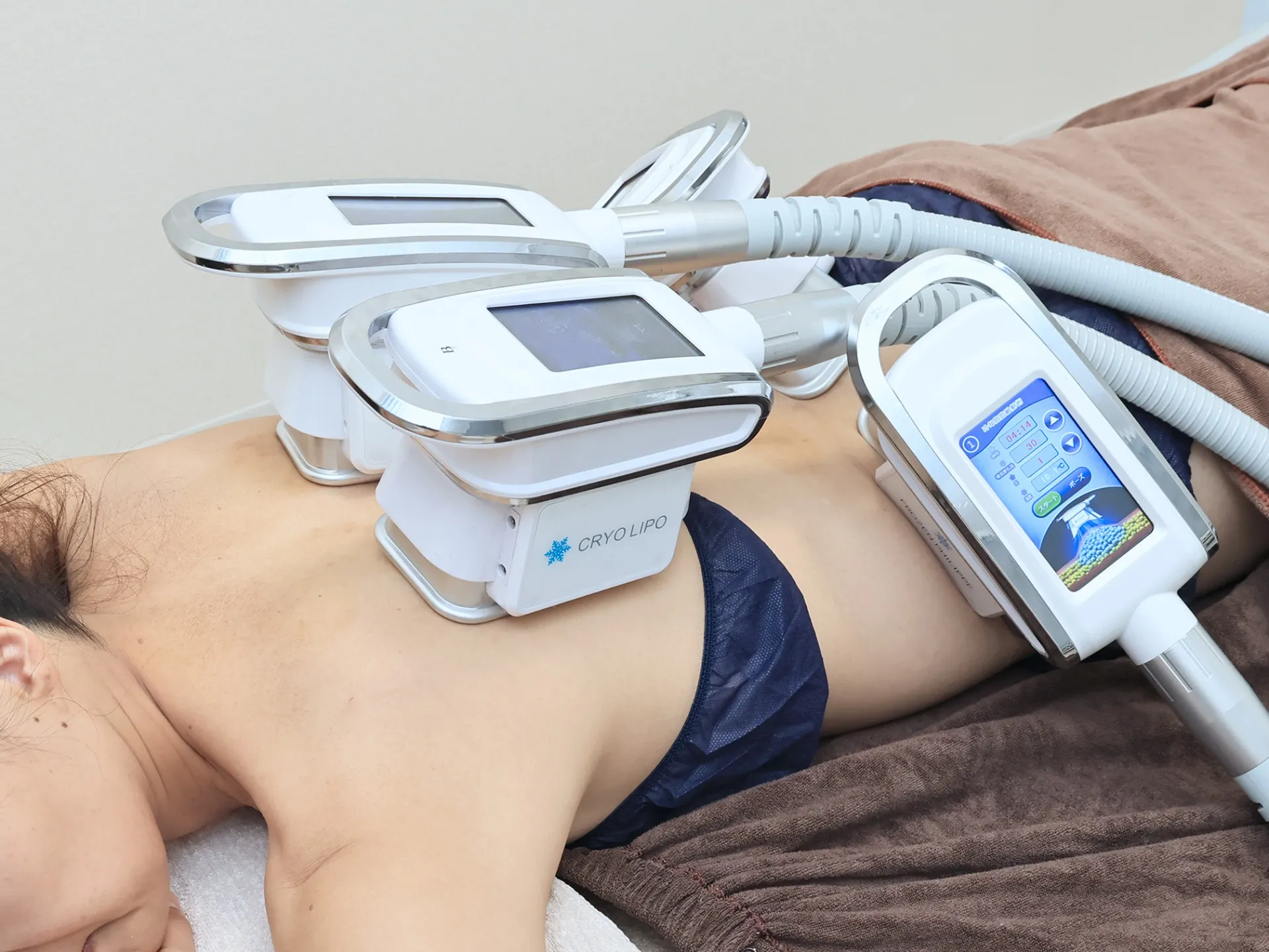 脂肪冷却施術例【背中×腰部4カップ】