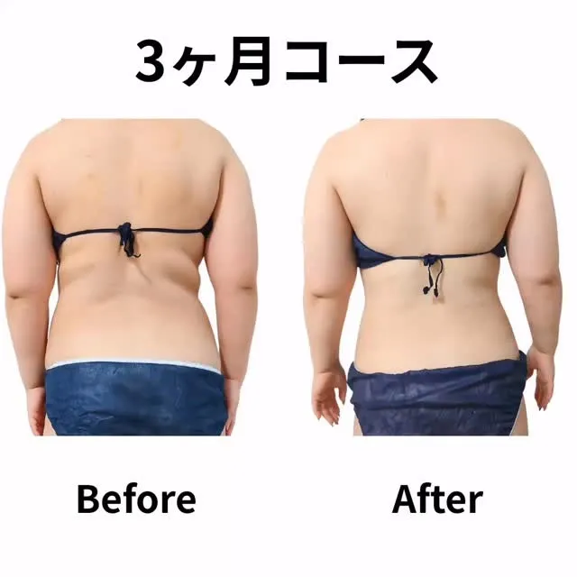 脂肪冷却×アフターフォローで